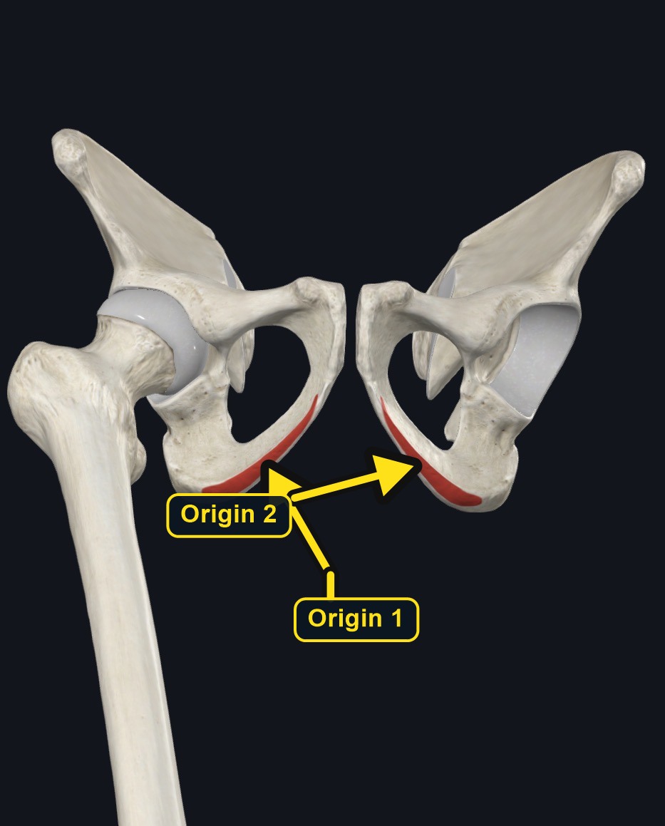 Pubic origin of adductor longus (arrows and labels mark the origin)