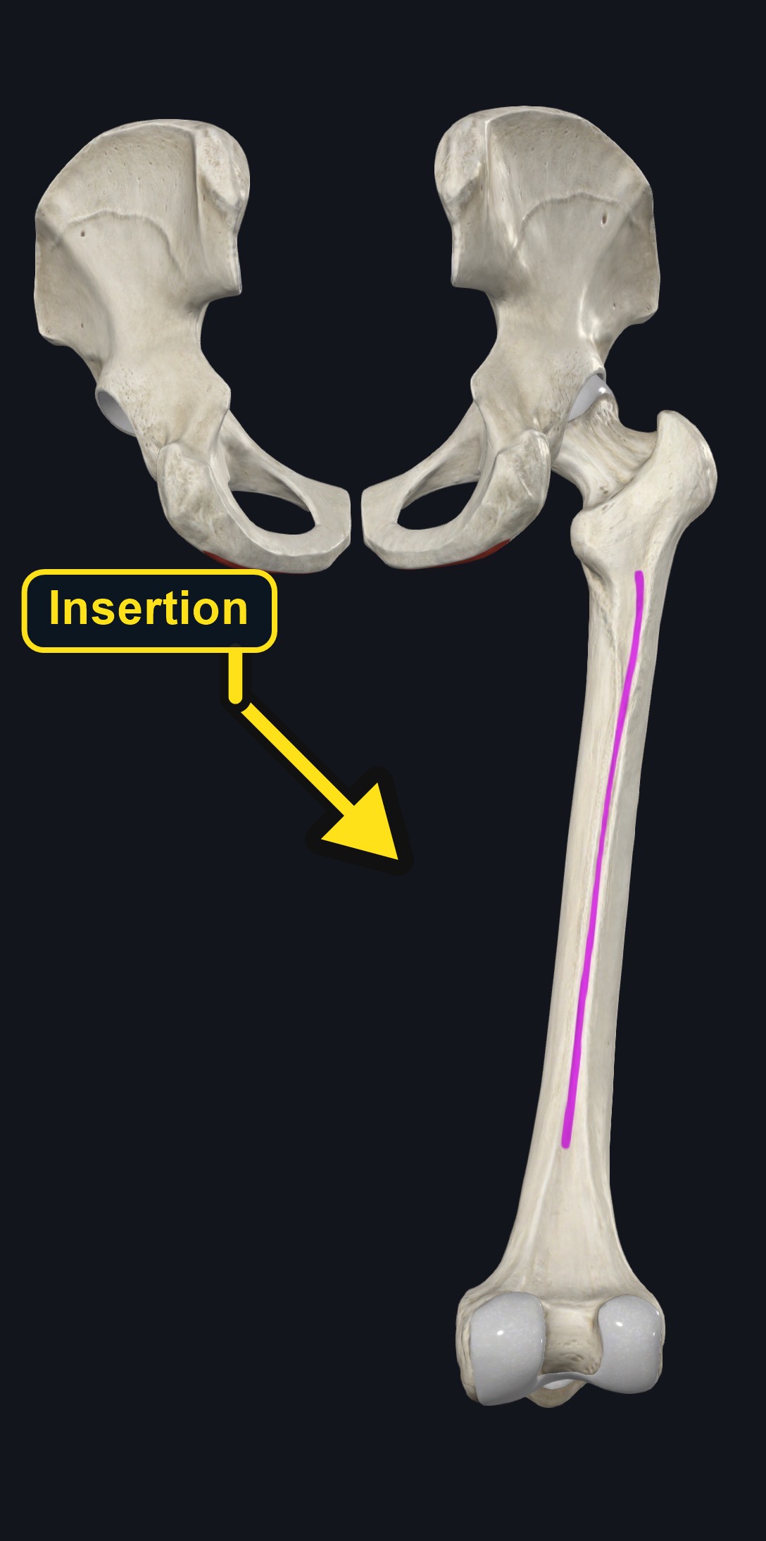 Femoral insertion of adductor longus on the linea aspera (arrows and labels mark the insertion)