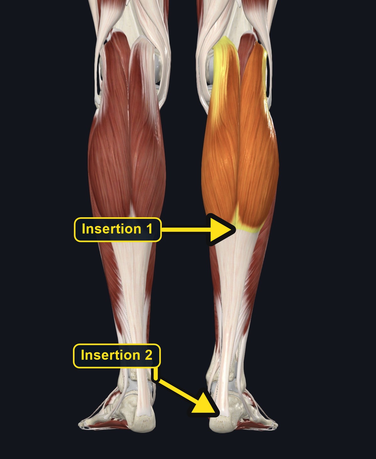 Gastrocnemius medial and lateral heads on the posterior leg (arrows and labels mark the insertion)