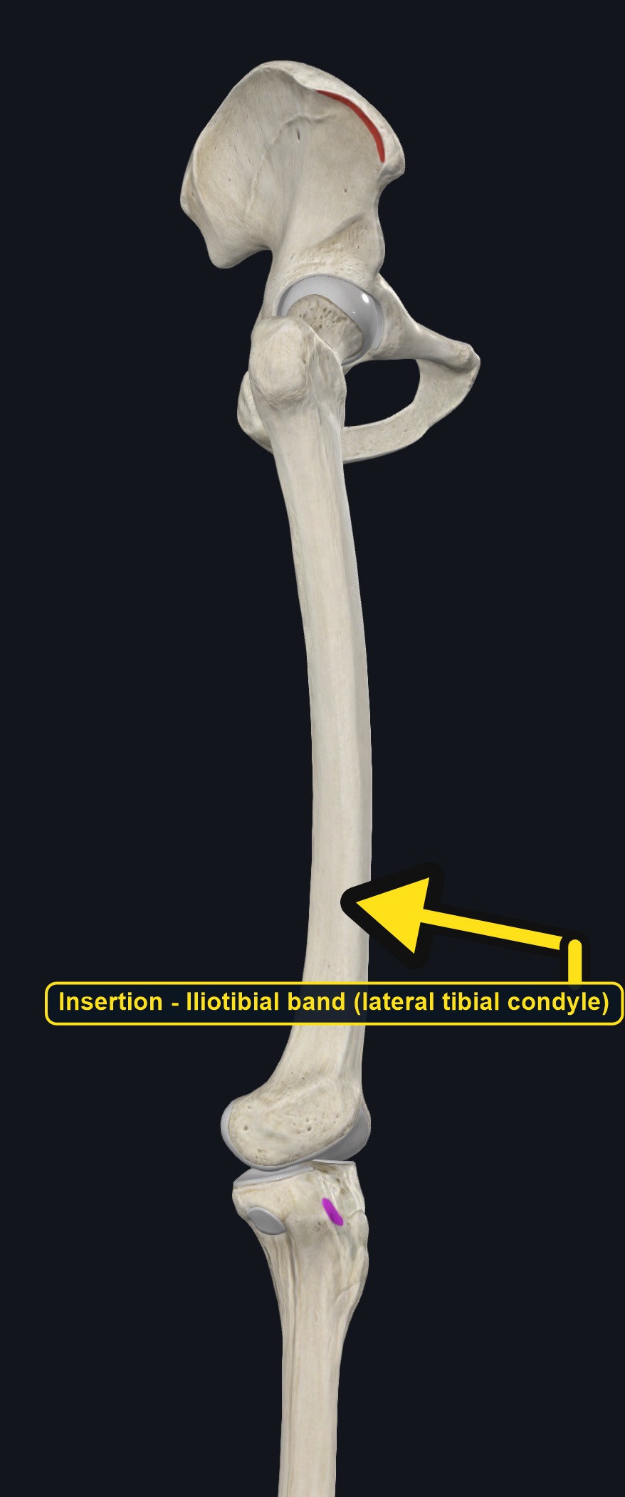 Insertion of the iliotibial band on the upper tibia (arrows and labels mark the insertion)