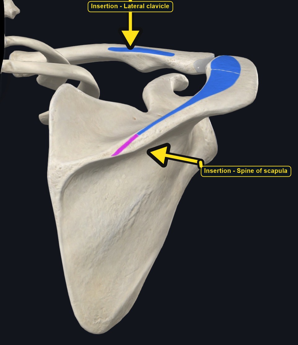 Scapula and clavicle with the insertion sites of trapezius marked (arrows and labels mark the insertion)