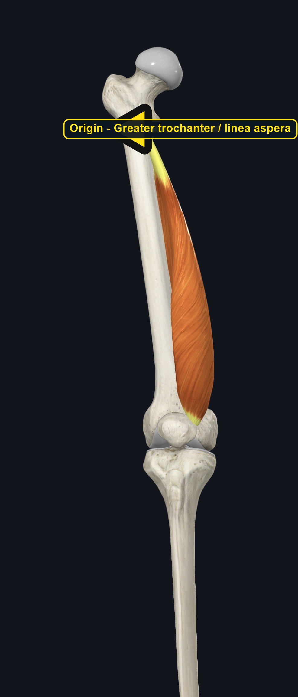 Femur with the origin of vastus lateralis marked (arrows and labels mark the origin)