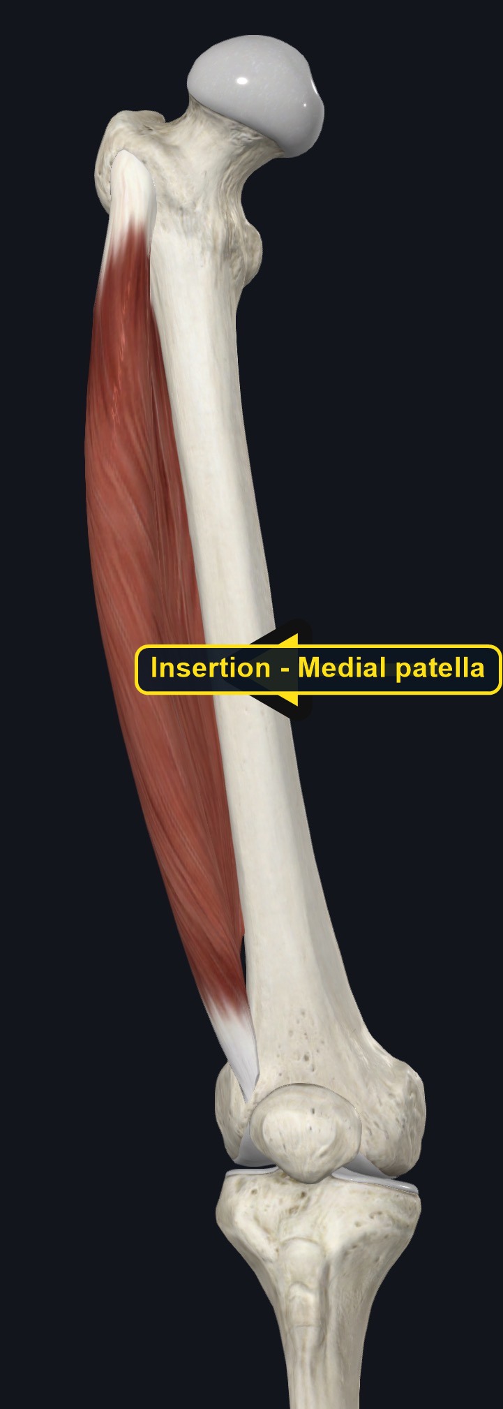 Femur and knee with the origin and insertion of vastus medialis marked (arrows and labels mark the insertion)